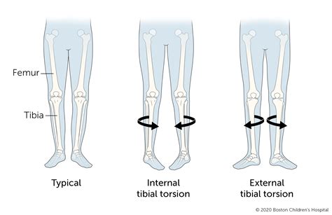 normal tibial torsion position